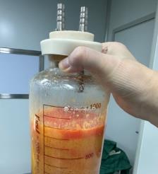 禹州水动力吸脂手术要做多久？